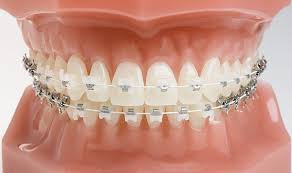 Dental Implants in davangere